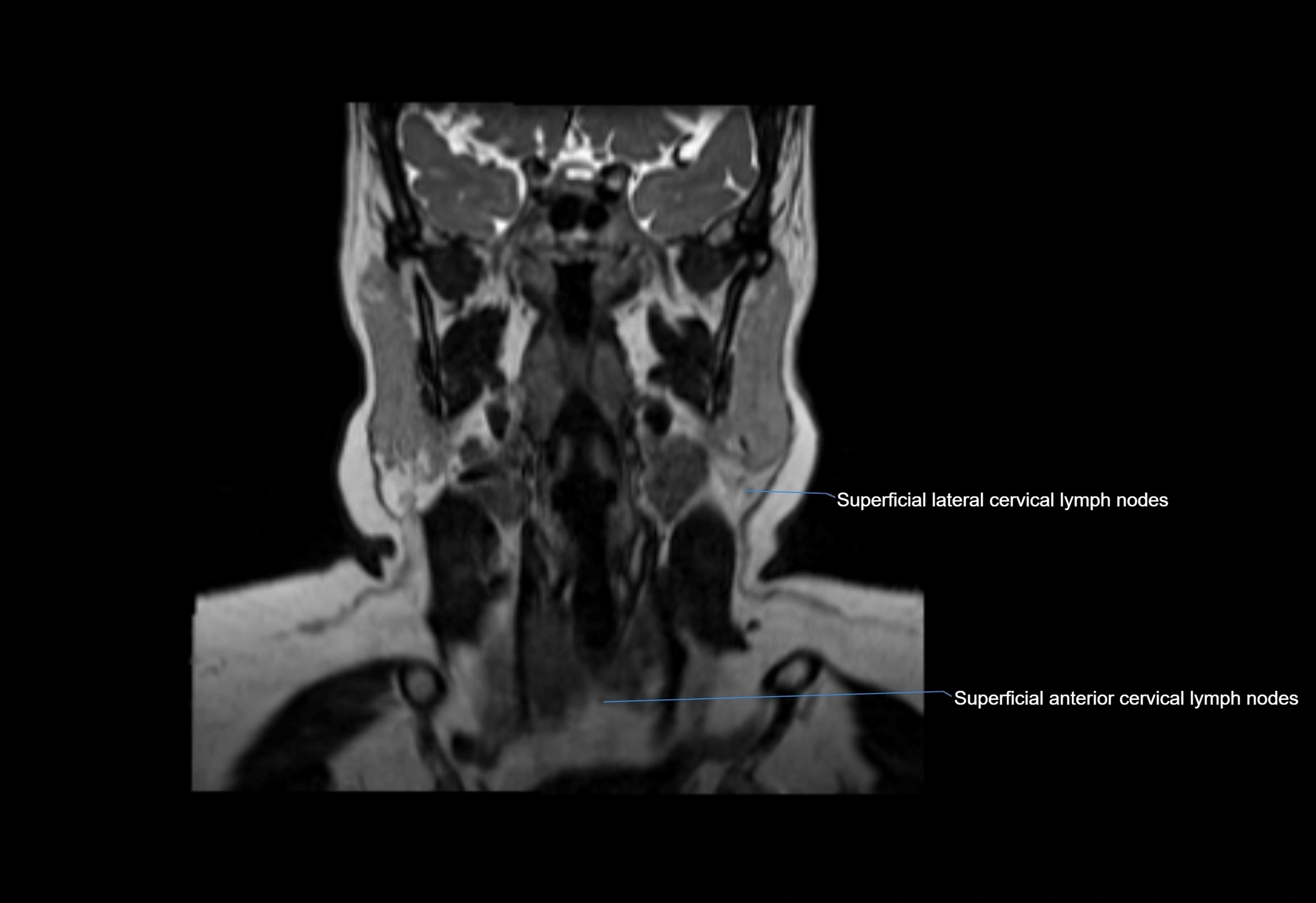 Neck coronal lymph node cross sectional MRI anatomy 3T MRI  image-img-00001-00043.webp